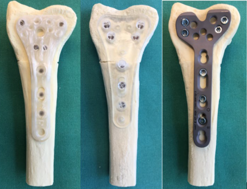Biomechanical testing samples for distal radius AFP with polymer implant, titanium implant and X3 fiber composite implant