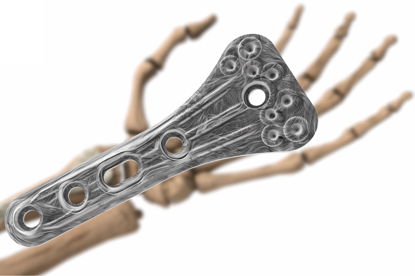 Strong biomaterials for orthopedic implants
